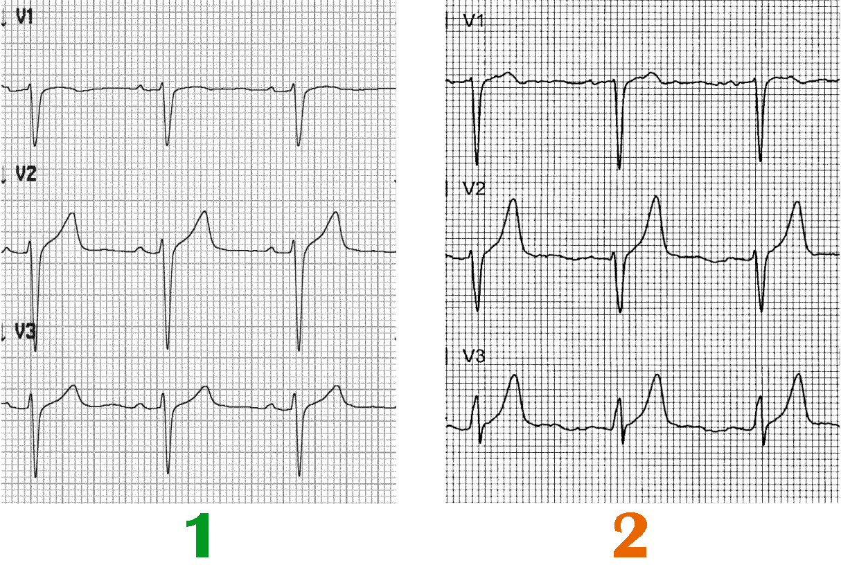 Экг отрицательный зубец т в v1-v3. Отрицательный т в отведении v1. Подъём зубца т в v3 v4. Зубец v1 v6 avl. Зубец т 2 3.