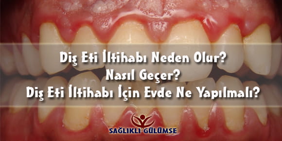 Sağlıklı Gülümse Diş Eti İltihabı Hakkında Her Şey