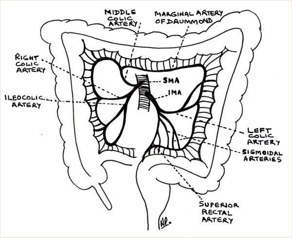 Mesenteric Ischaemia - Time is Bowel - Emergency Medicine ... diagram of cecal volvulus 