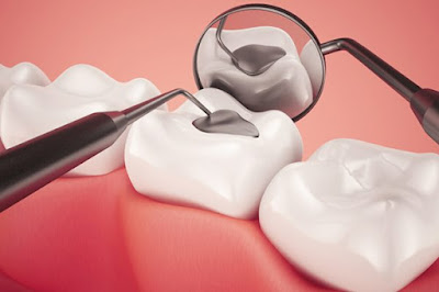 Các chất liệu trám răng áp dụng tại nha khoa