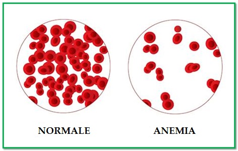 Risultati immagini per anemia