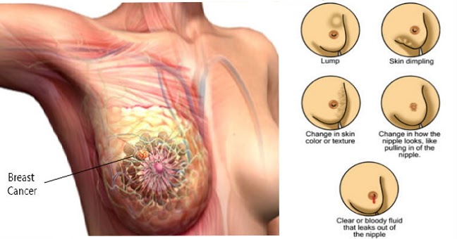Important Signs Of Breast Cancer You May Not Know About