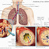Asthma dan penawarnya