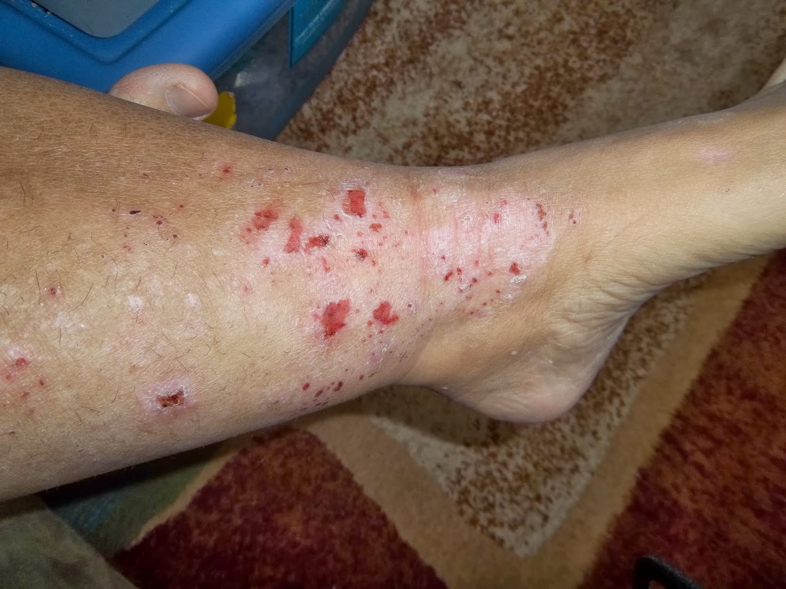 Stopping Topical Steroids 12.5 month update pictures