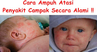 obat campak obat campak