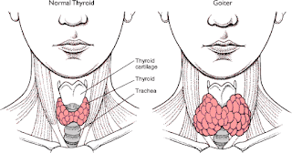 Beberapa Penyakit Yang Menyebabkan Hipertiroid
