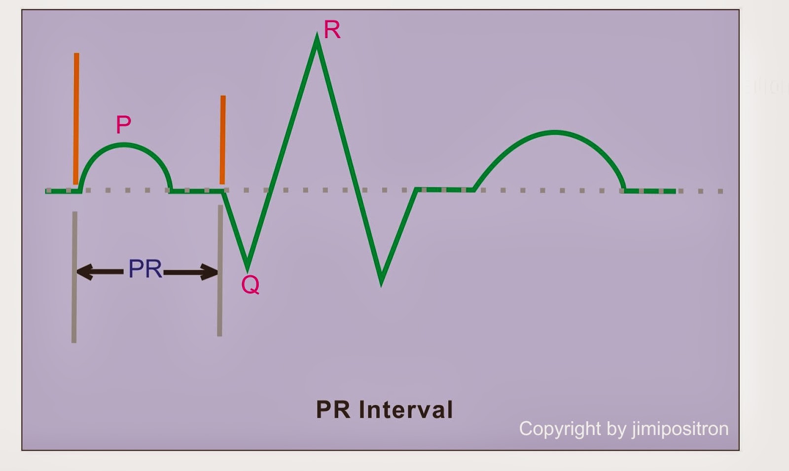 интервал pr. продолжительность интервала pq на экг в норме составляет. интервал pq. Av block 1 degree. интервал pr.