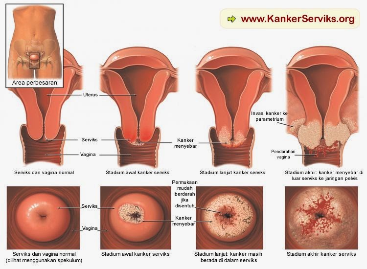 obat tumor serviks, obat serviks, pengobatan kanker serviks