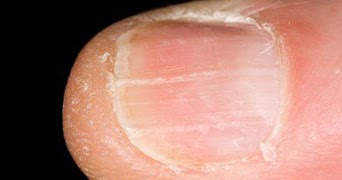 Dry fingernails with ridges - Awesome Nail