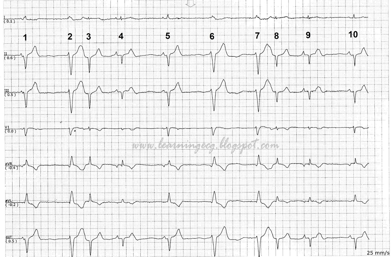 ECG Rhythms Do we have the same ladder diagram?