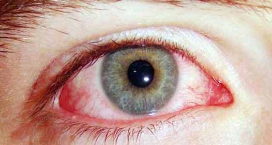 goz kanlanmasi nedenleri ve tedavi