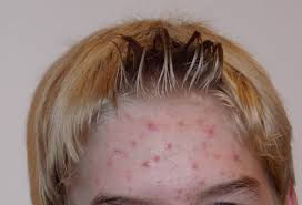 Whatever the cause, acne is very much in existence across America