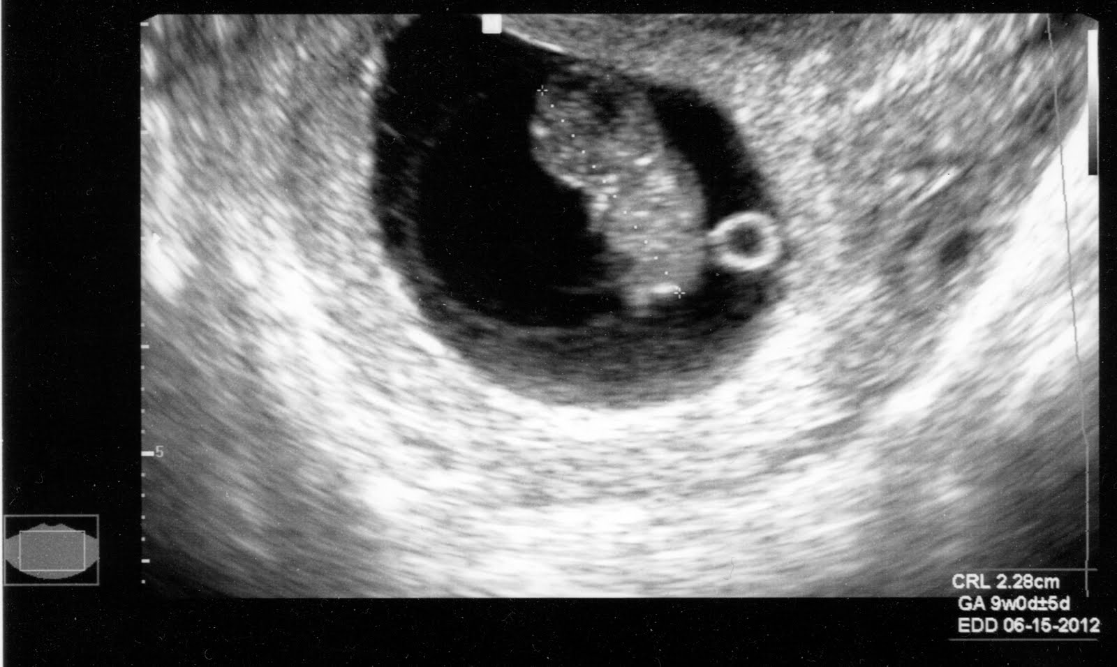 6 эмбриональная неделя. Фото эмбриона на 6 неделе беременности на УЗИ. УЗИ 6-7 недель беременности. УЗИ 7 недель беременности фото. 6 Недель беременности фото плода на УЗИ.