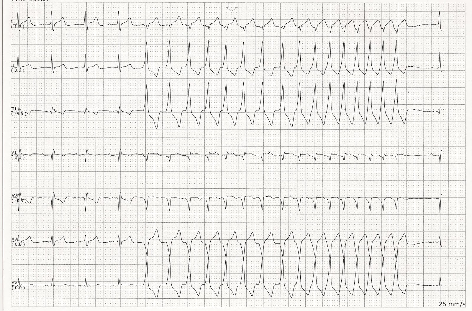 Sinus rhythm with nonsustained VT