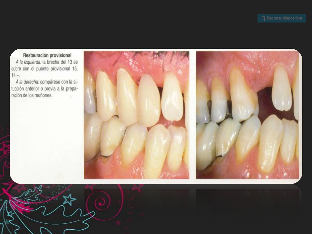 Provisionales dentales