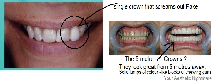 How Much Is A Crown >> What Is The Lifespan Of A Dental Crown Or Cap And Why Do Prices Vary How Much Is A Crown >> What Is The Lifespan Of A Dental Crown Or Cap And Why Do Prices Vary