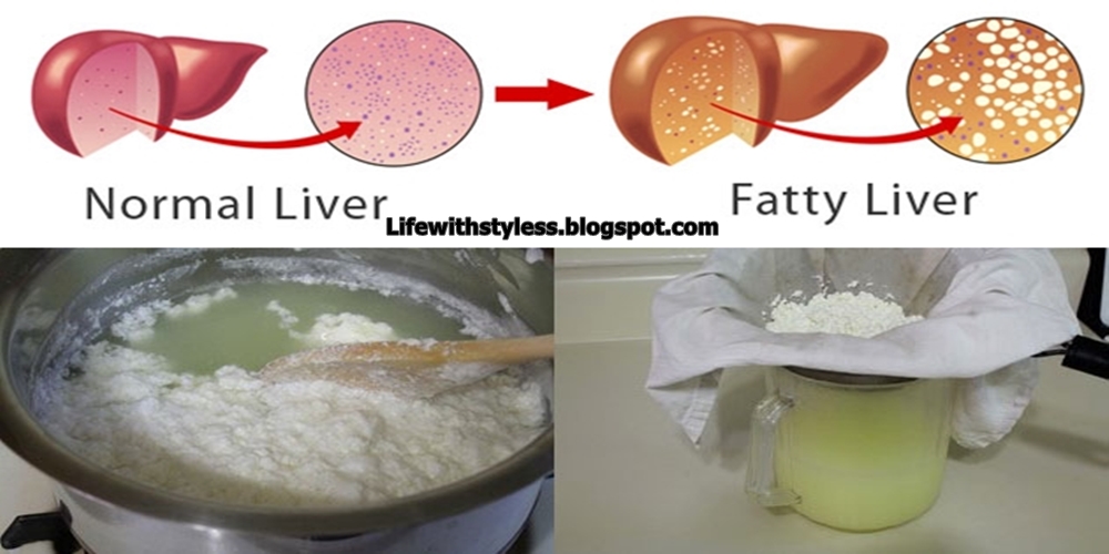 Have a Fatty Liver? How to Cleanse It! Life With Styles