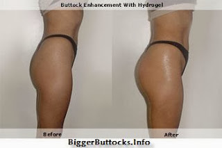 Hydrogel Buttocks Injections Before After Photos