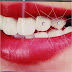Tẩy trắng răng bằng phương pháp Bleachbright