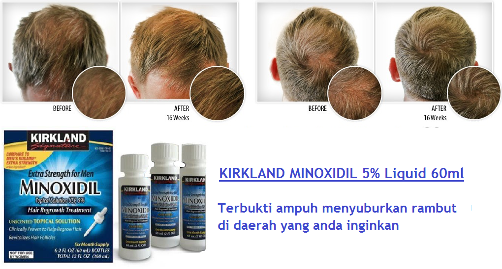Obat Penumbuh Rambut Ampuh dan Cepat Terpopuler di Tahun 2017 | Jual