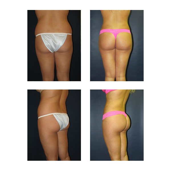 Buttock augmentation brazilian butt lift