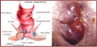 Obat Wasir Alami di Apotik