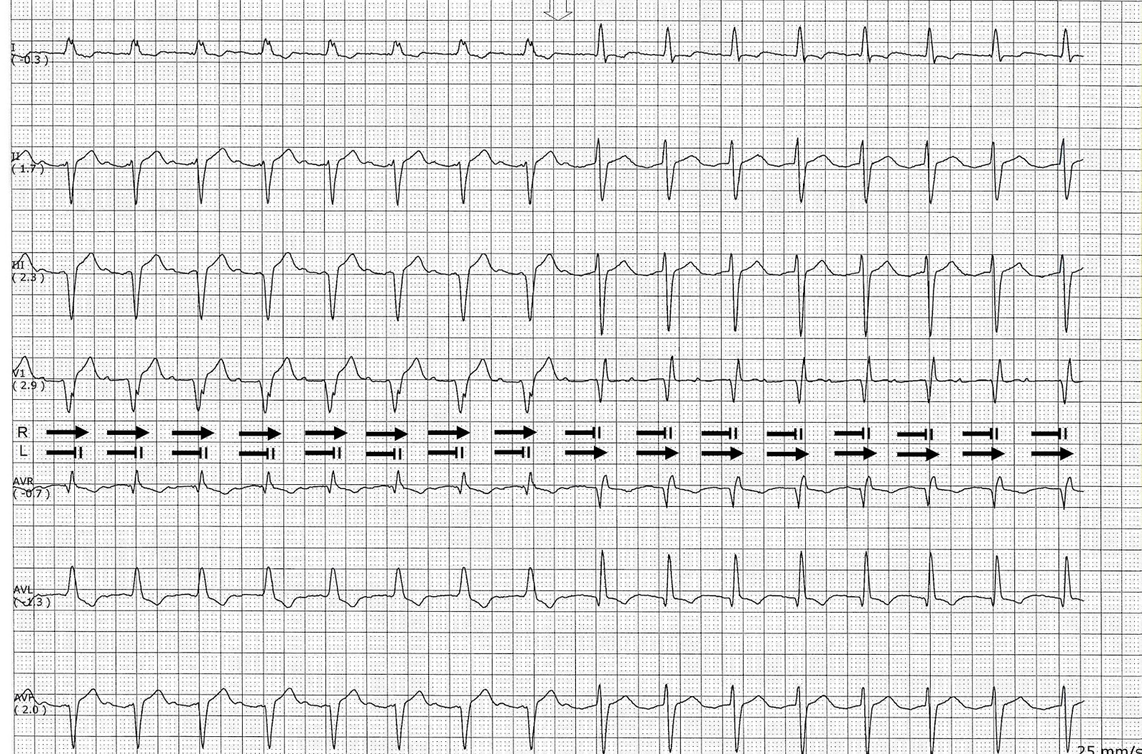 ECG Rhythms Bilateral Bundle Branch Block