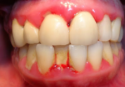 Viêm lợi sau khi bọc răng do đâu?
