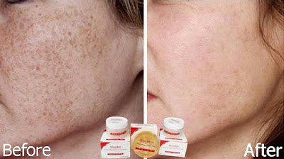 Cream Wajah Penghilang Kokoloteun Liyoskin Cream Wajah Penghilang Kokoloteun