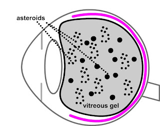 Asteroid Hyalosis Images, Symptoms, Causes, Treatment