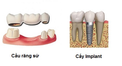 cay-ghep-rang-implant-nha-khoa-thuan-kieu-2015