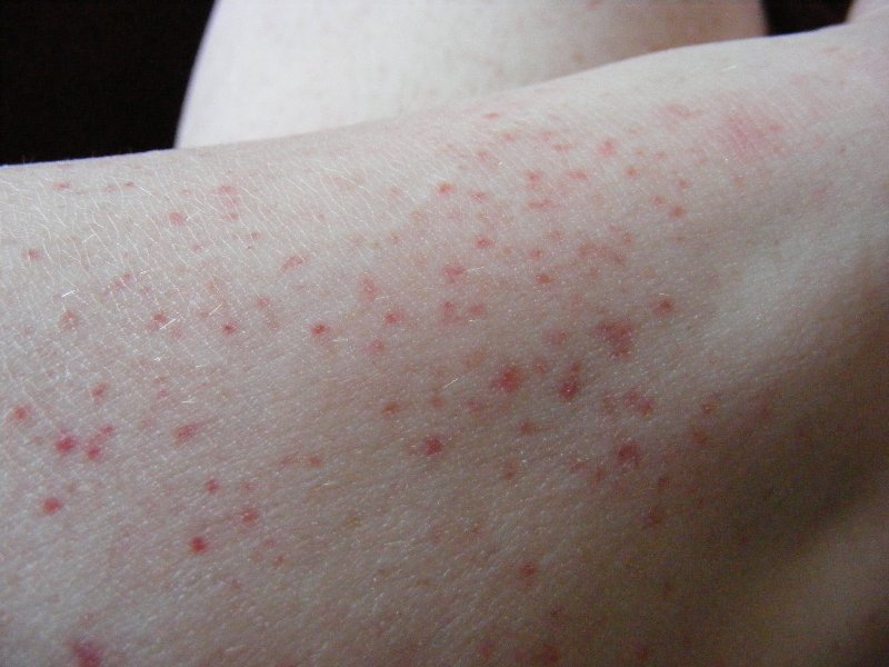 red splotches on lower legs #11