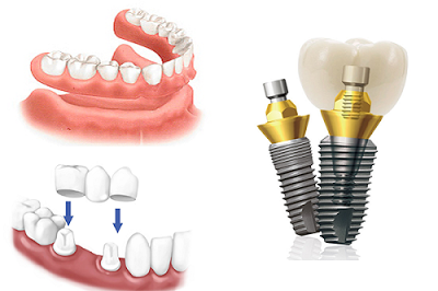 Các cách phục hình răng với Implant