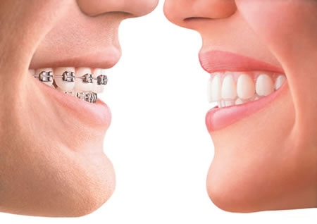 Nguyên nhân gây sự lệch lạc răng và sai hình xương hàm