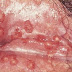 Obat sipilis yang terbaik thumbnail