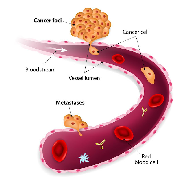 Cancer De Seno Con Metastasis