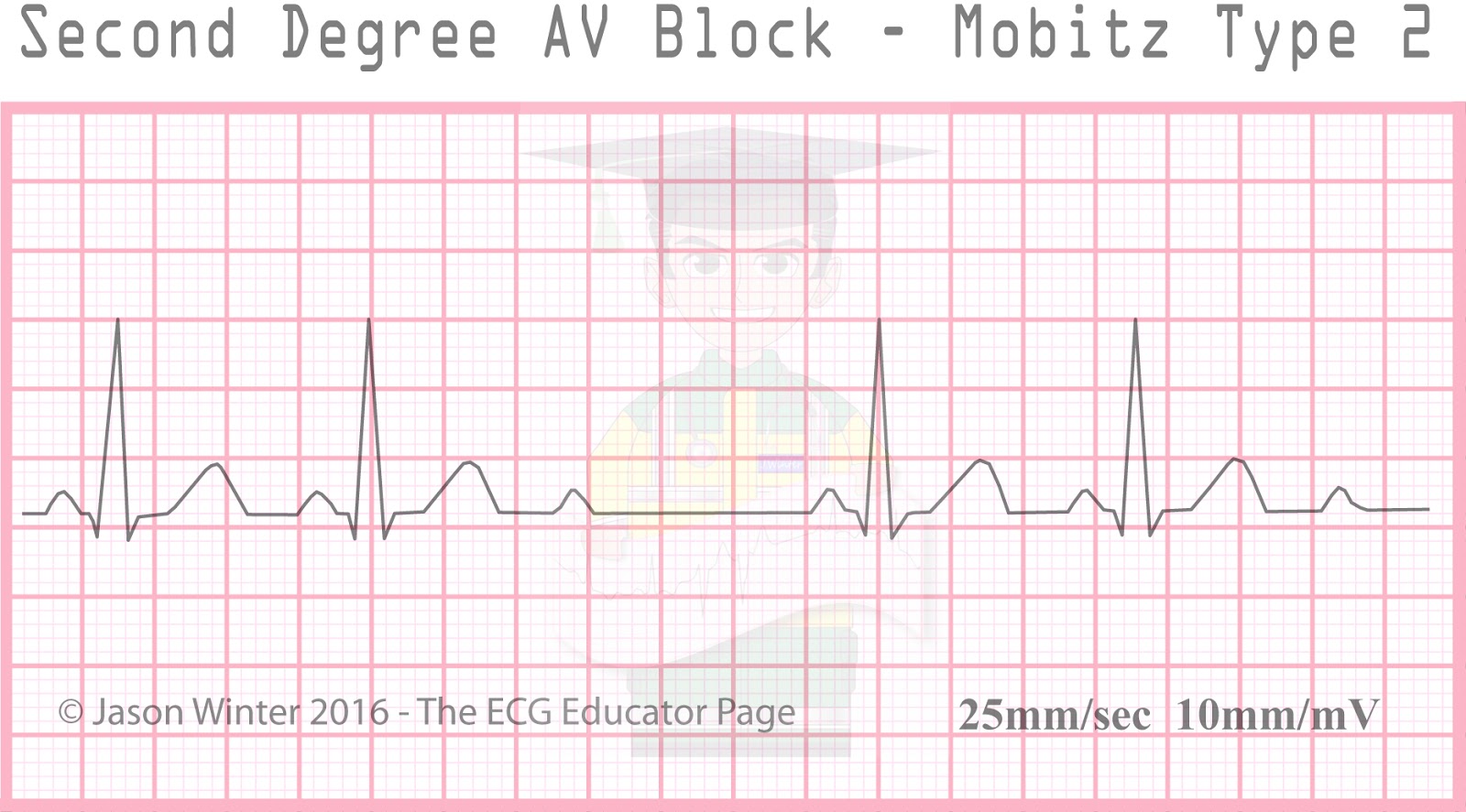 ECG Educator Blog Heart Blocks