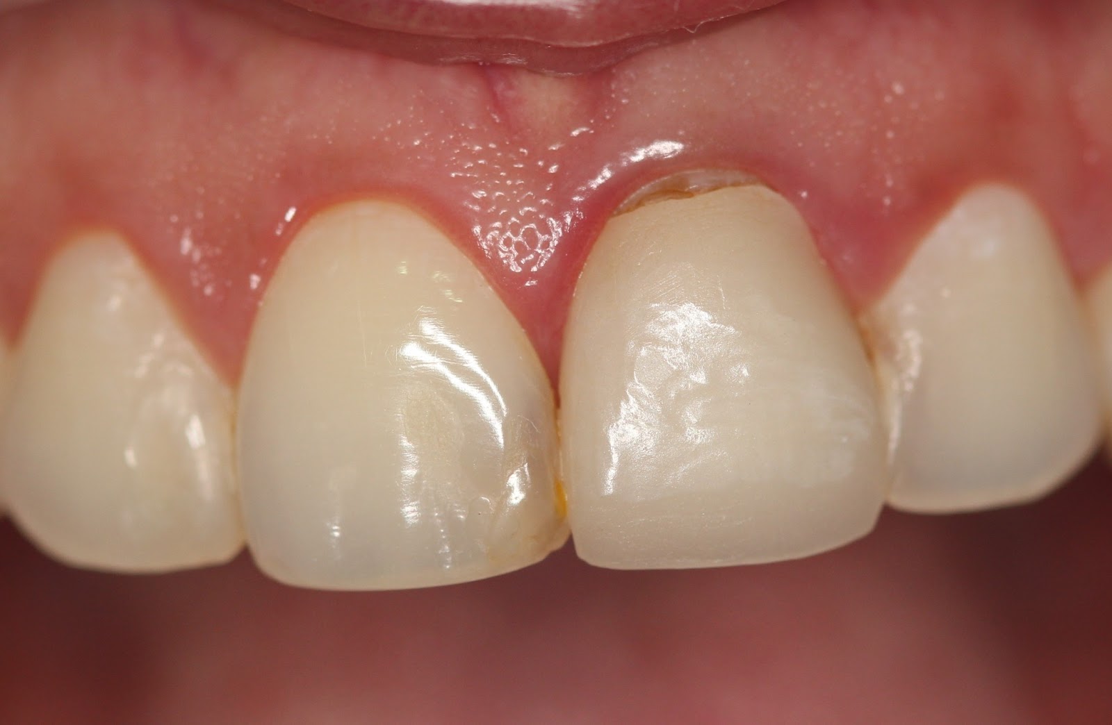 Orthotrain: Fracture of an Upper Incisor Restoration
