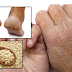 How to Treat Dry Skin, Cracked Heels, And Eczema At Home Fast