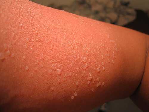 Trattamento di unguento di eczema con propolis