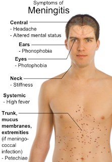 meningitis symptoms signs ear risks preventions face neck diagram infection flu brain bacterial health diseases nursing therapy children