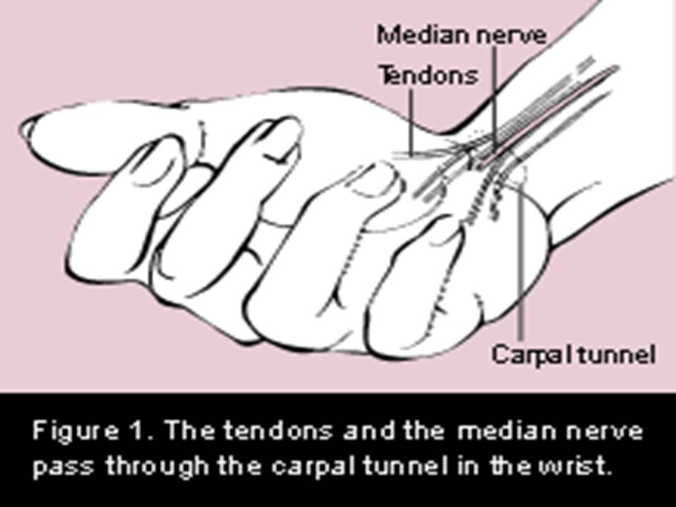 Nyeri Ekstremitas (Carpal Tunnel Syndrome) .