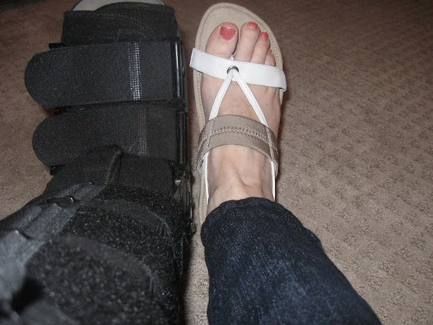 20 Plantar Fasciitis Cast Pictures And Ideas On Carver Museum
