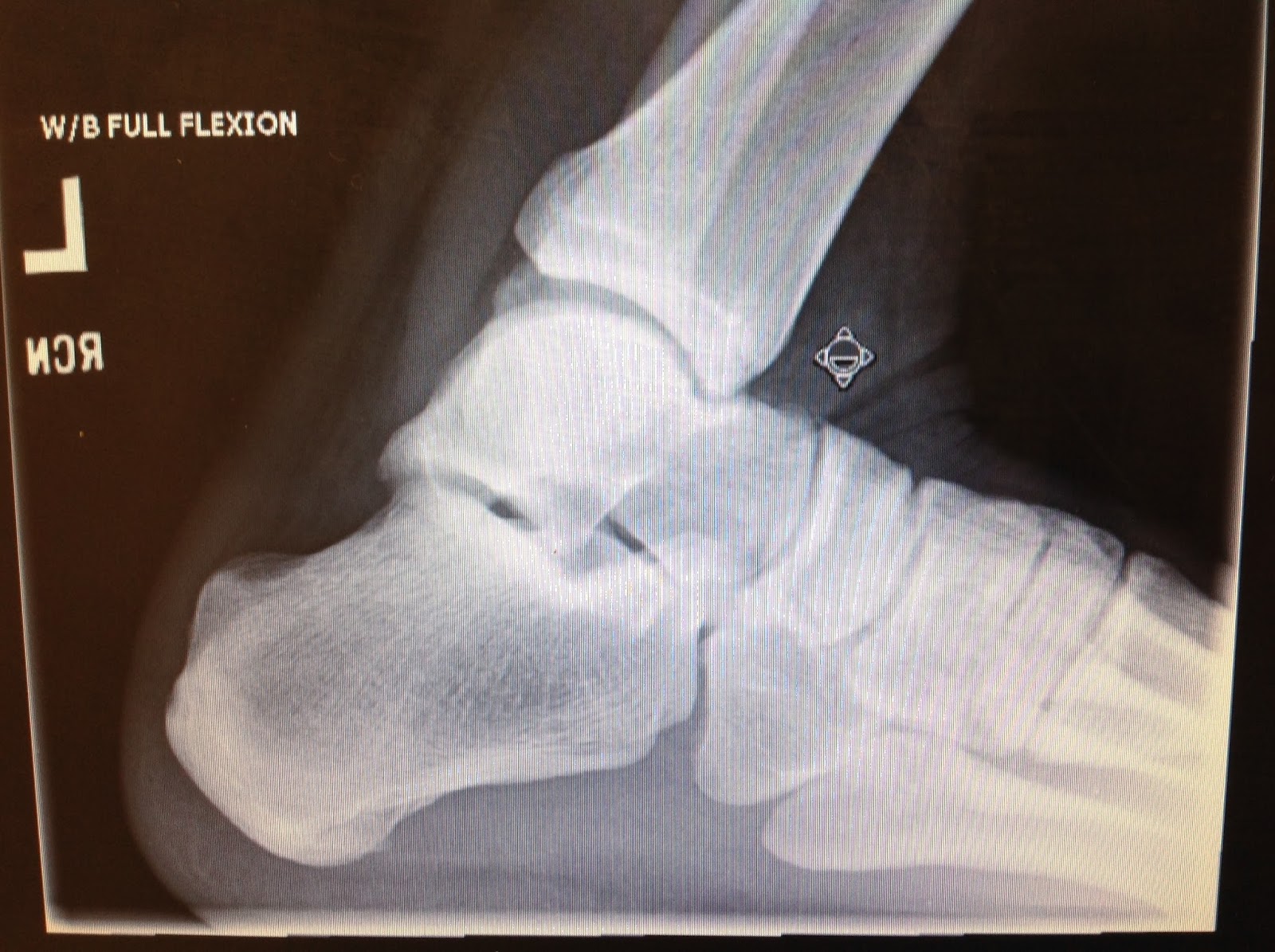 Foot and Ankle Problems By Dr. Richard Blake Anterior (Front) Ankle