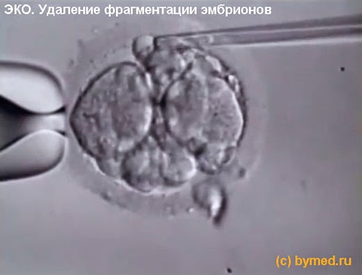 Подсаживали 2 эмбриона. Эмбрион при эко. Подсадка эмбрионов при эко. Фрагментация эмбриона. ИКСИ эмбрион.