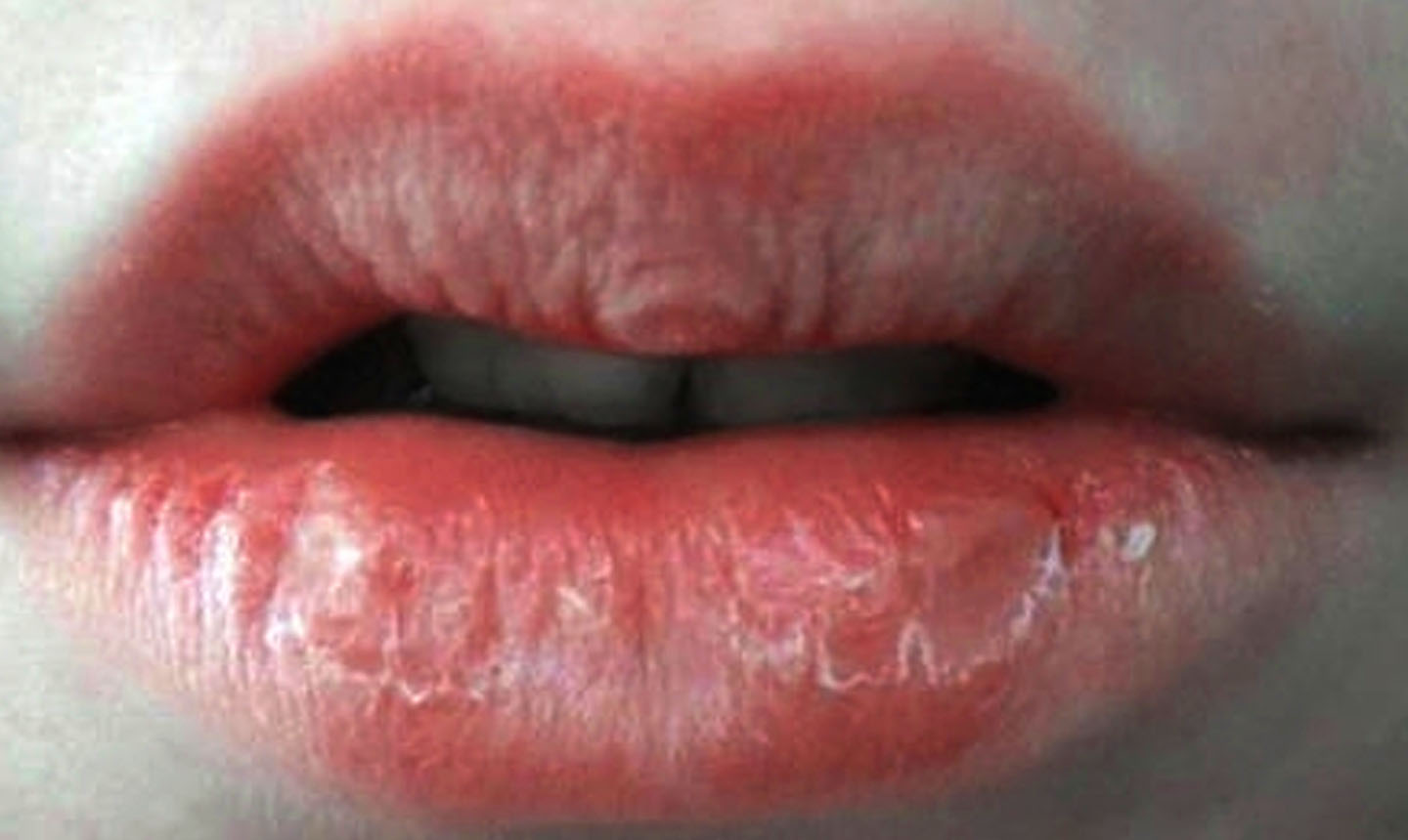 Easy way to treat dry lips and cracked with natural remedies Good info