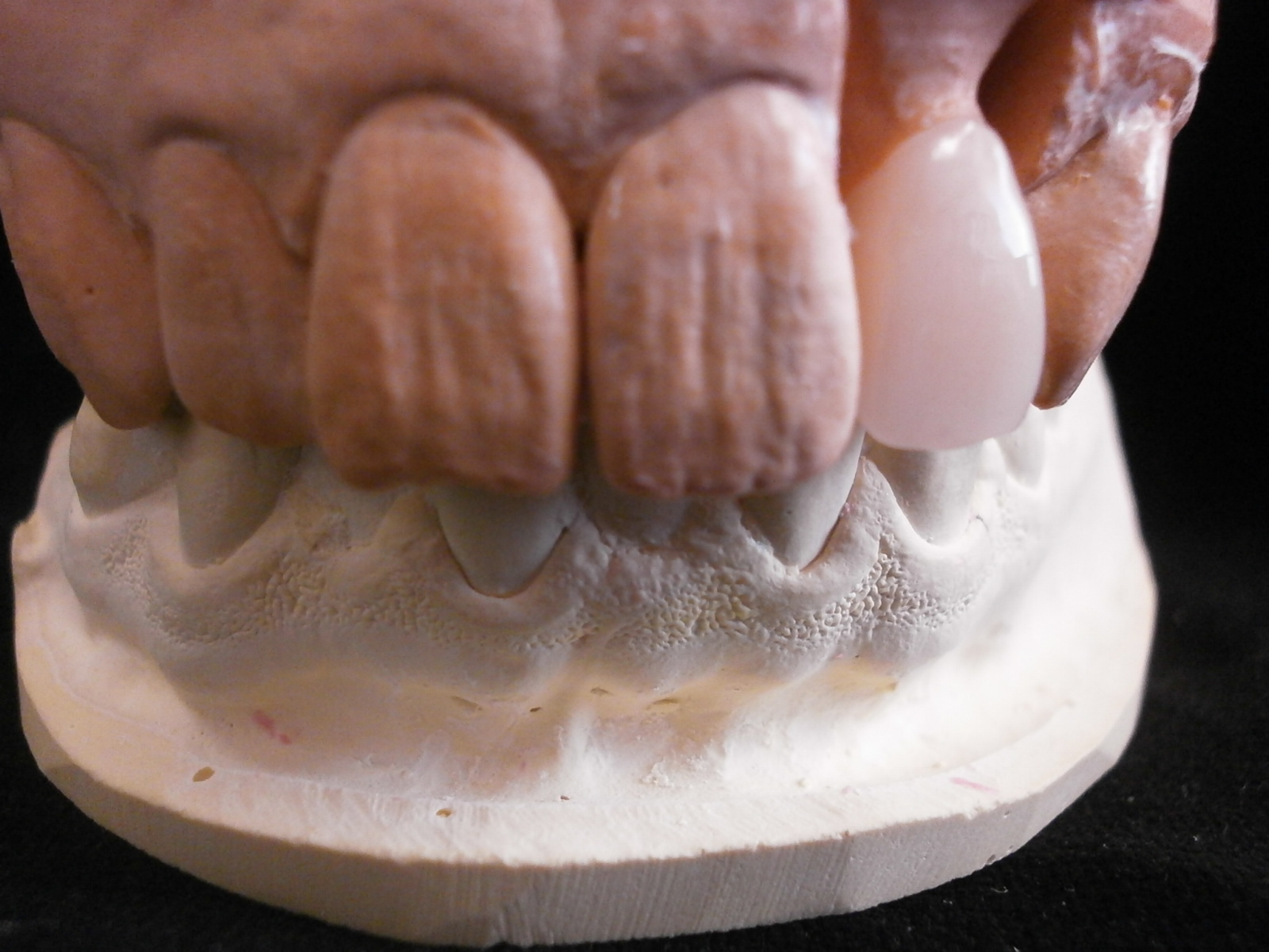 髙田朝（Hajime Takada）のオーダーメイド歯科技工物の紹介 Introduction of custommade dental