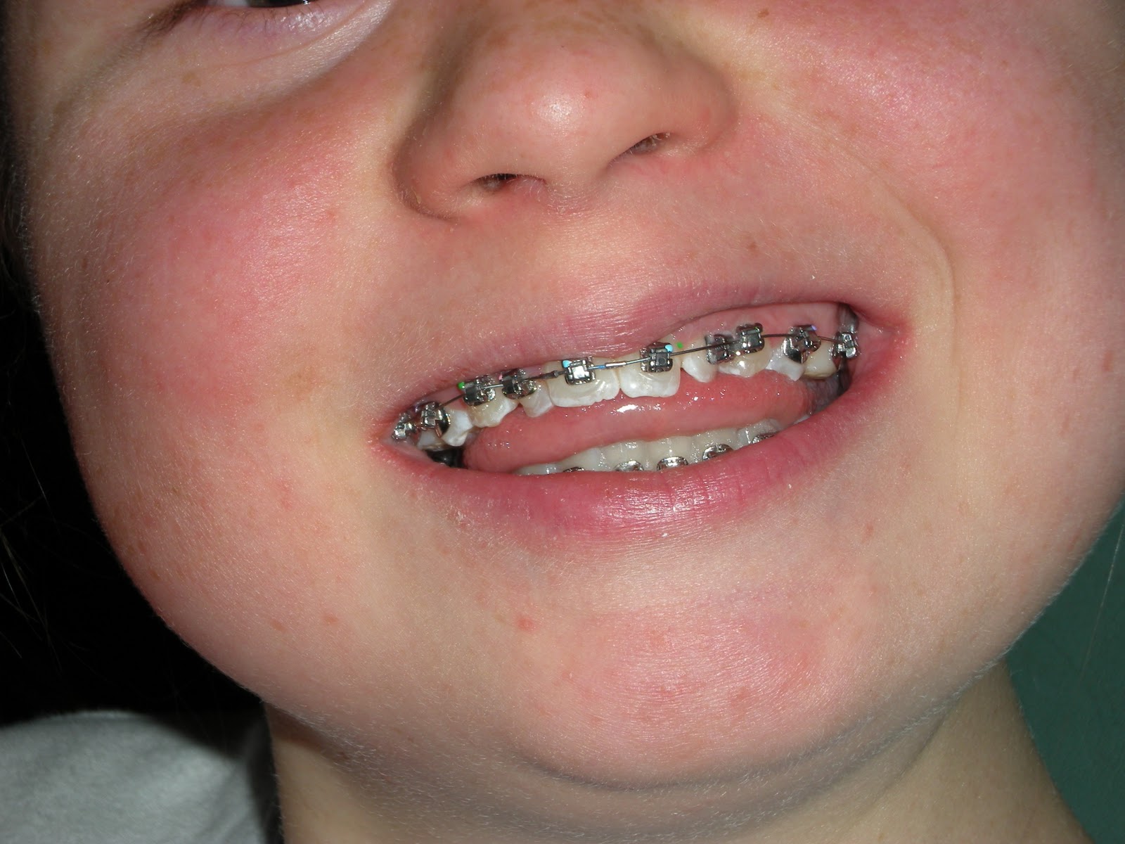 Care Bear Design The braces come off!