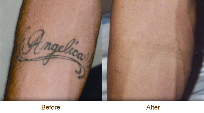 ... which tattoos removal product to use and tca tattoos removal is the