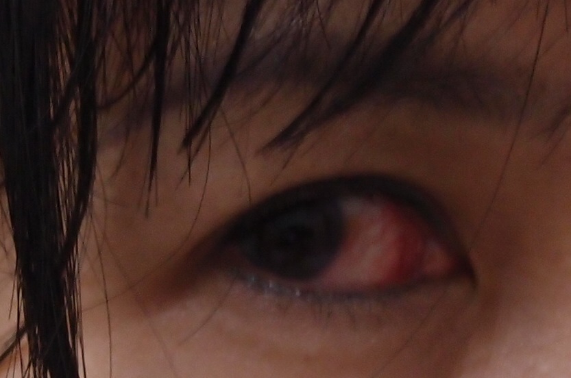 Xing Fu BLOODSHOT EYES AFTER MIGRAINE ATTACK